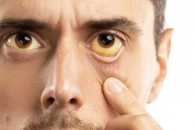 Желтуха: основное заболевание, приводящее к изменению цвета глаз